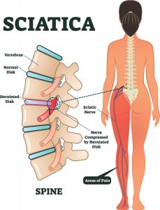 my sciatica