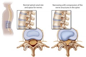 spinal stenosis