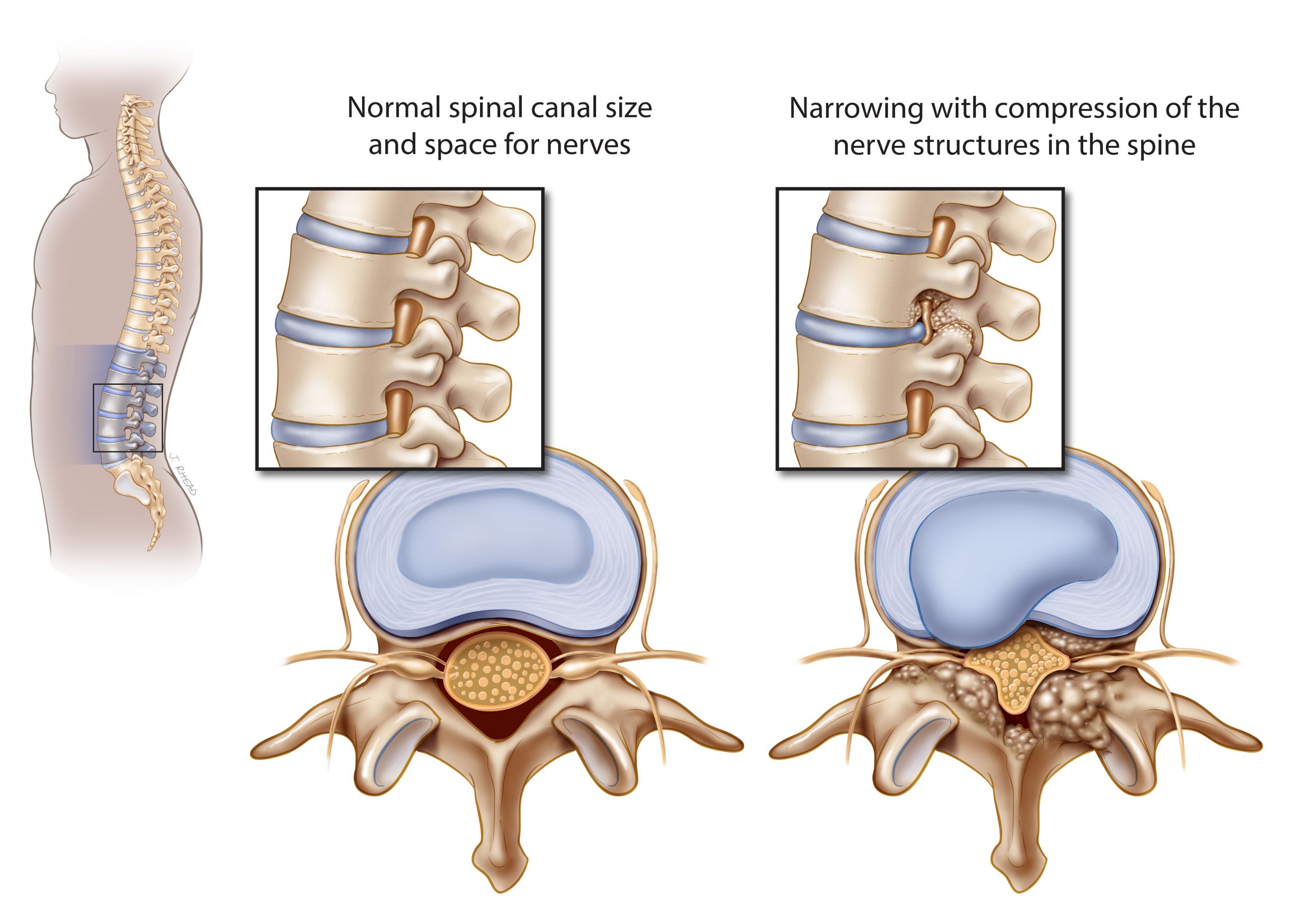 lumbar spinal stenosis illustration scaled
